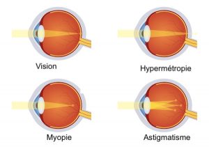 myopie astigmatisme hypermetropie